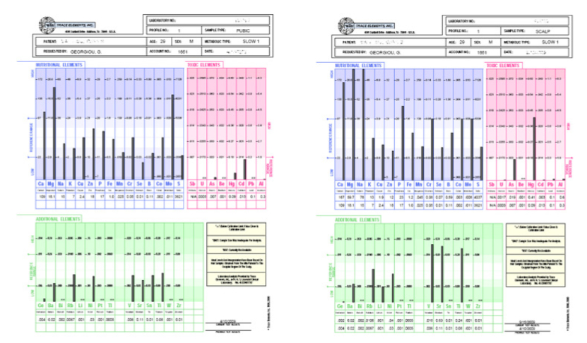 Hair test results for this patient also shows off the body cleansing properties of HMD