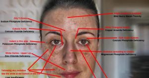 signs of heavy metal toxicity