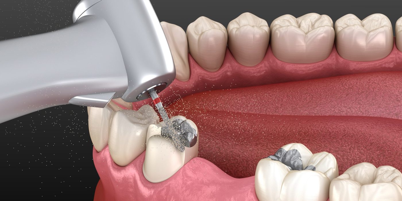 Dental Amalgams